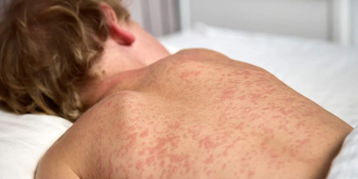 Measles outbreaks expose the costs of rejecting public health, with lessons from the AIDS crisis